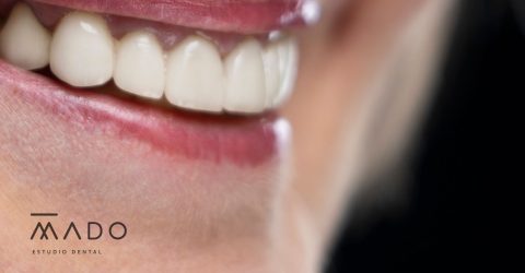 implantes cerámicos de zirconio odontología biológica Madrid