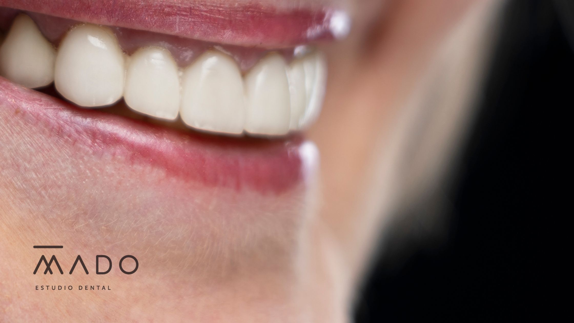 implantes cerámicos de zirconio odontología biológica Madrid